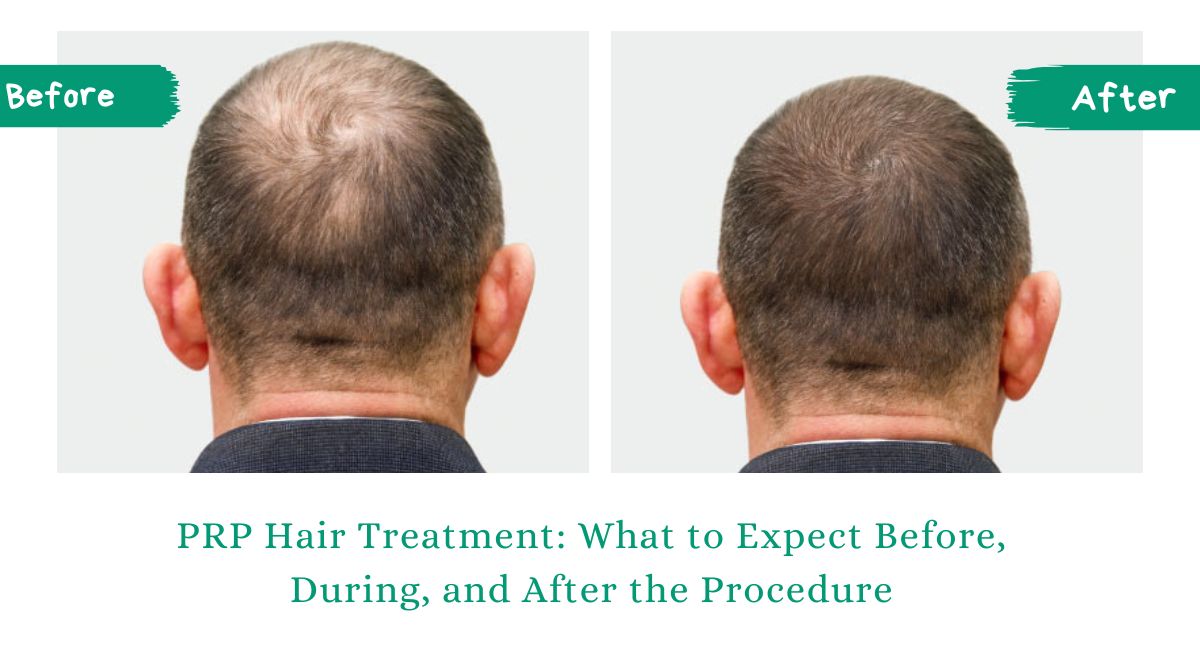 PRP Hair Treatment: What to Expect Before, During, and After the Procedure